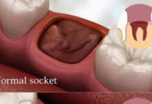 healing normal socket after tooth extraction