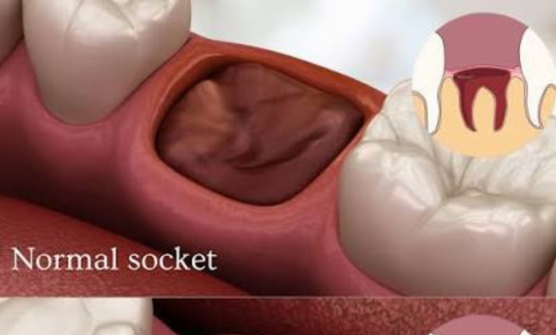 healing normal socket after tooth extraction